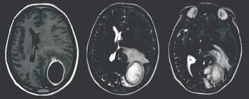 Image result for Brain Abscess