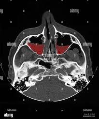 Image result for Sinus CT