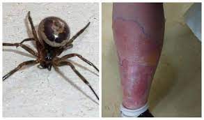 Then it feels as if damaged by a small pin. Woman Hospitalised For A Week After False Widow Spider Bite Leinster Express