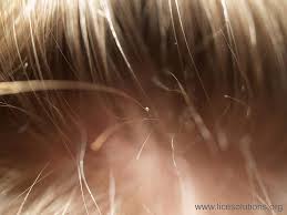 Pin On Pictures Of Head Lice