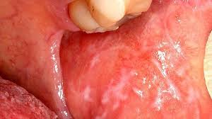 Image result for lichen planus on tongue)