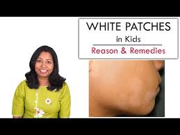 Pityriasis alba (which is latin for white, scaly patches), is the most common cause. 7 Super Easy Ways To Remove White Patches On Baby Face