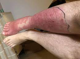 Sepsis is a serious infection that causes your immune system to attack your body. Erysipel Wikipedia