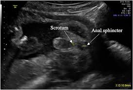 Fetal Anogenital Distance Using Ultrasound Aydin 2019 Prenatal Diagnosis Wiley Online Library