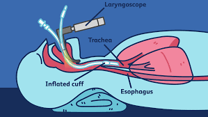 You can also check out previous 1:1 consulting and advocacy sessions with me how long can she safely be on the intubation before we are risking everything? What Is Intubation And Why Is It Done