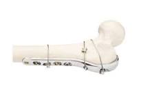 Orthopaedic Cable System | Products | DePuy Synthes