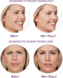 Botox is an extremely straightforward treatment that does not require significant downtime. Botox Cosmetic Onabotulinumtoxina Official Site Welcome Botox Botox Cosmetic Medical Skin Care