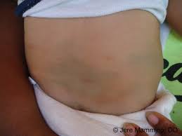Due to the fact that pediatric skin cancer is extremely rare, most babies do not receive a diagnosis of melanoma. Mongolian Spot American Osteopathic College Of Dermatology Aocd