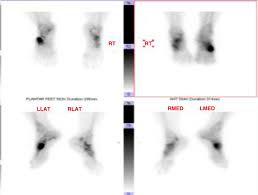 Image result for Osteomyelitis Bone Scan