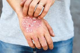 Image result for psoriasis