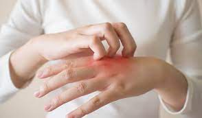 Best 9 Home Remedies For Fungal Infection That Will Give You Relief! | Be  Beautiful India