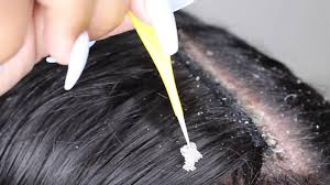May 25, 2018 · the oldest known case of dandruff has been identified in a small feathered dinosaur that roamed the earth about 125m years ago. If You Re Thinking Of Scraping Your Dandruff For Likes Please Don T Bbc Three