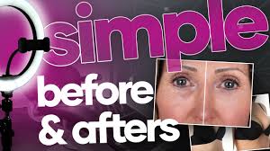 Before & After Photos Are Still Very Important for Your Medical Aesthetic  Practice