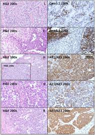 Stomach cancer, also known as gastric cancer, is a fairly uncommon form of cancer in the united states, accounting for 1.5% of all cancers diagnosed each year. Mesothelioma Scientific Clues For Prevention Diagnosis And Therapy Carbone 2019 Ca A Cancer Journal For Clinicians Wiley Online Library