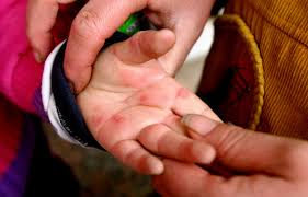 Explainer Why Children Are At Risk Of Hand Foot And Mouth Disease Bhekisisa