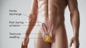 Image result for gonorrhea symptoms