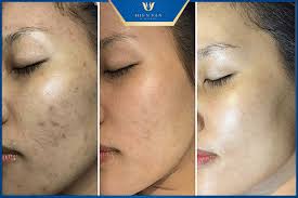 Peel da trị nám có tốt không? Ưu điểm và nhược điểm