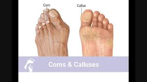Check spelling or type a new query. Causes Of Corn Country Foot Care
