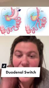 Reply to @amberrain74 #duodenalswitch #duodenal #bariatricsurgery  #duodenalswitchsurgery #weightlosssurgery #wls #extremeweightloss  #bariatricqueen