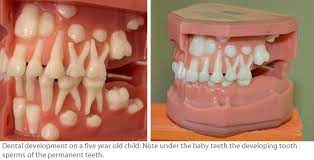 Cyprus Society Of Paediatric Dentistry Are Baby Teeth Important After All They Will Be Replaced