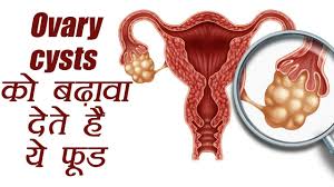 Ovarian Cyst ज न क य ह ओवर स स ट क न स Food बढ त ह इस ब म र क Pcos Boldsky Youtube