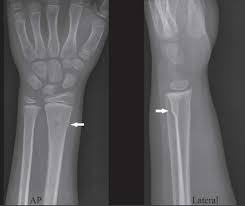 A stable fracture, such as a buckle fracture, may require 3 to 4 weeks in a cast. Buckle Fracture Causes Symptoms Diagnosis Treatment