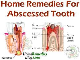 Best Home Remedies For Abscess Tooth Abscess Tooth Teeth Remedies Tooth Abcess Remedy