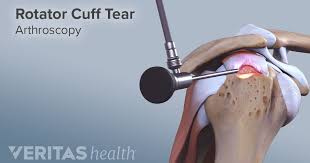 Rotator Cuff Surgery Recovery Rotator Cuff Surgery Rotator Cuff Surgery Recovery Rotator Cuff