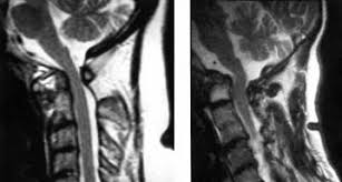 Mri Scans In Rheumatoid Arthritis Left Mobile Atlantoaxial Download Scientific Diagram