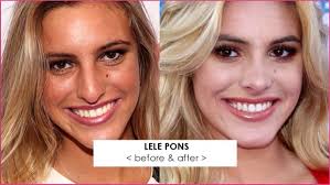 10 Teenage Celebrities Who Ve Had Nose Jobs Under The Age Of 18 Details Website Celebrity Celebrities Beforeand Nose Job Plastic Surgery Victoria Secret