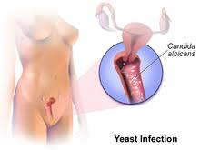 Check spelling or type a new query. Vaginal Yeast Infection Wikipedia