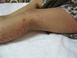 Risultati immagini per leptospirosi