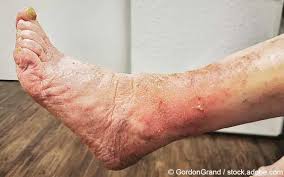 Image result for erysipel photos)