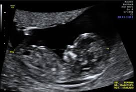 Die weiterführende, differenzierte organdiagnostik (auch fehlbildungsultraschall, feindiagnostik oder oft auch vereinfachend „großer ultraschall genannt). Ersttrimester Ultraschall Fruhe Feindiagnostik Nackenfaltenmessung Praxis Fur Pranatale Diagnostik