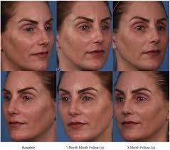 Investigating the efficacy of a fractionated 1927 nm laser for diffuse  dyspigmentation and actinic changes