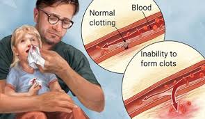 The mission of cdc's division of blood disorders is to reduce the morbidity and mortality from blood disorders. Hemophilia Bleeding Disorder With A Person
