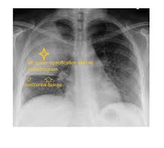 Image result for Air Bronchogram