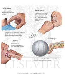 Jersey finger (also called rugby finger or sweater finger) describes a type of injury where there is avulsion of the flexor digitorum profundus (fdp) from the volar base of the distal phalanx base 1. Jersey Finger Boxer Fracture Fight Bite Mallet Finger