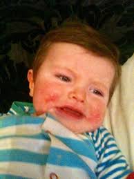 Boy's severe eczema that left his skin red raw and oozing pus is 'cured by  miracle treatment'