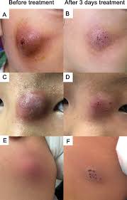Image result for Skin Abscess