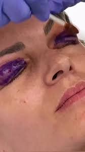 👁 Is an Eye Lift the Secret to a More Youthful You?, An upper  blepharoplasty, often referred to as an “”eye lift,”” can work wonders in  opening up your eyes and rejuvenating your face. This delicate ...