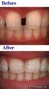 Bonding Gaps Between Teeth With High Cosmetic Bonding Dental Cosmetics Teeth Bonding