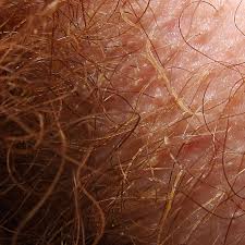 Ingrown armpit hairs are hairs that have the infected region gradually puts on a yellow or white bump like structure that oozes out pus or similar. Trichobacteriosis Axillaris Wikipedia