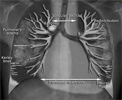 The Radiology Assistant Heart Failure On the image on the left notice the following the radiology assistant heart failure
