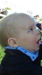 6 Wochen Post Op...... ......ihr Lieben, hier wieder ein kleines Update von  uns..... Viele haben mir "damals" vor der Op gesagt, warte ab Janine, zu  seinem 1. Geburtstag ist alles vergessen.......pfffff dachte