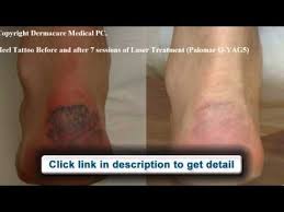 2.5 out of 5 stars. Tattoo Removal Cream