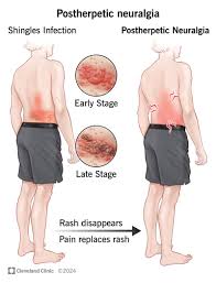 Image result for shingles