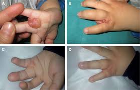 Image result for Syndactyly