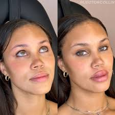 SMIZE FOR DAYS 😍👀 0.5 cc of Kysse with a focus