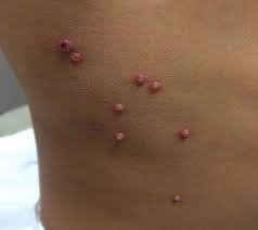 This medication is used on the skin to treat common skin and foot (plantar) warts. Cantharidin Treatment For Molluscum Durban Skin Doctor